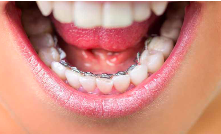 İçten Diş Teli Tedavisi Nasıl Olur?